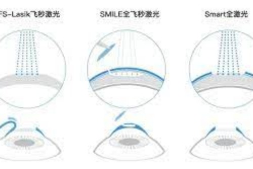 近视眼手术方式 近视眼手术方式