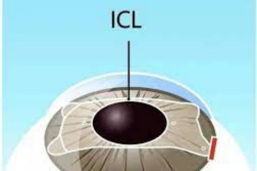 ICL晶体植入 ICL晶体植入