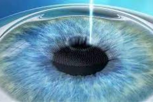 近视眼手术宣传图 近视眼手术宣传图