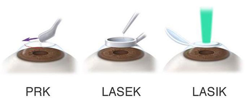 三种近视手术方式