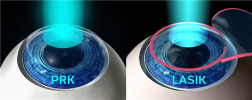 PRK和LASIK术式对比