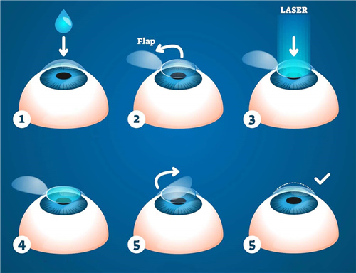 近视手术详细步骤