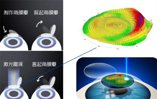 飞秒手术示意图