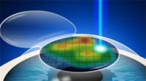 近视手术实拍图