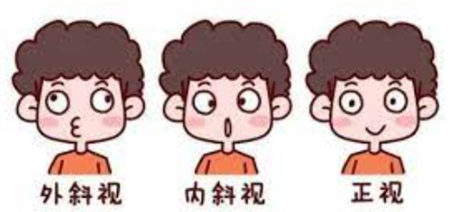 斜视卡通图示意图