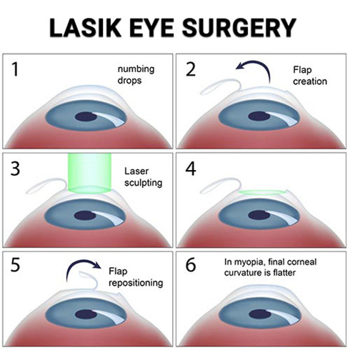 近视眼图示说明