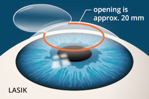 近视眼手术图解