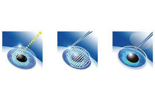 全飞秒手术过程图