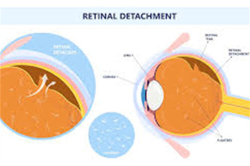 眼前有小飞蝇飞飞飞,检查说是飞蝇症?飞蝇症状以及治疗方式~