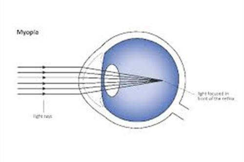 瞳孔示意图 瞳孔示意图