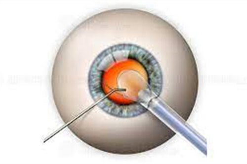 你不知道的近视眼小秘密！近视眼手术常见问题快问快答~