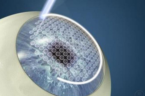 全飞秒手术示意图