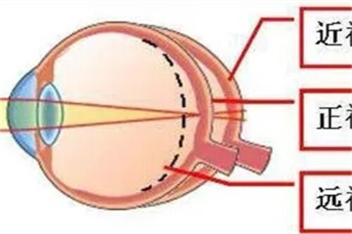 不同视力成像对比图
