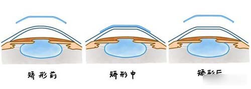 近视矫正前中后期对比漫画图
