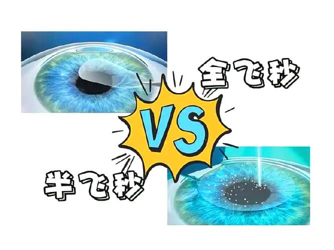 全飞秒与半飞秒近视手术:哪种更好?全飞秒是否终身有效?