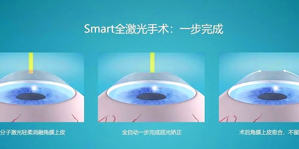 全飞秒手术步骤图