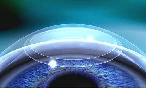 近视手术细节图