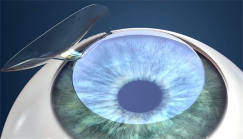 半飞秒激光手术切口