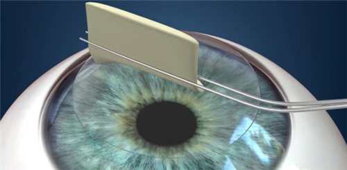 飞秒手术操作中