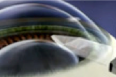 揭秘：ICL晶体会不会脱落、掉出来或者移位？概率极小！