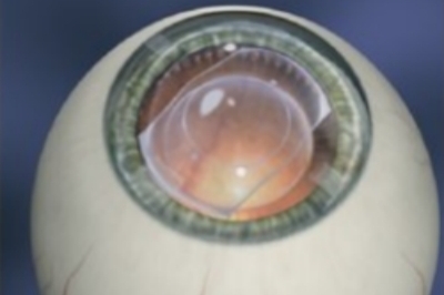 ICL晶体植入过程