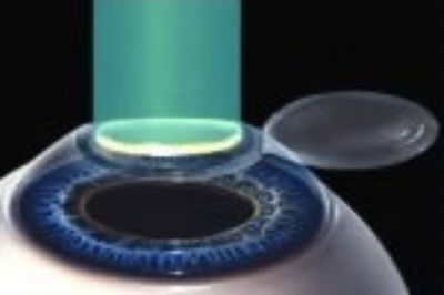 准分子激光手术