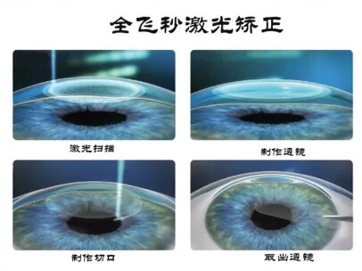 全飞秒近视眼手术过程示意图