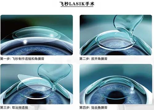 飞秒lasik手术过程示意图