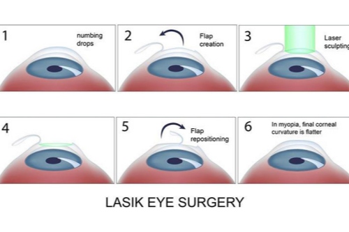准分子激光手术