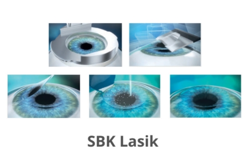 lasik动画示意图 lasik动画示意图