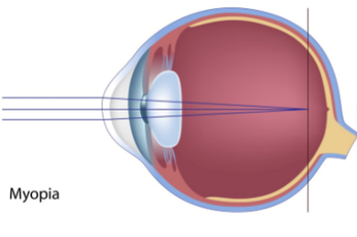 高度近视眼球示意图