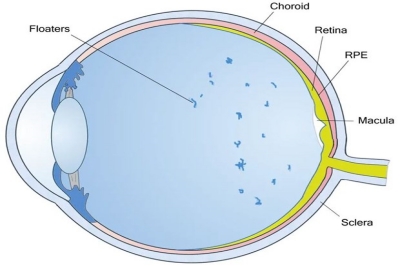 飞蚊症解析：眼中的“飞蚊”是什么？造成原因以及治疗方案是什么？