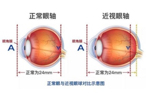 怎样选择适合自己的近视手术治疗？做完手术后该怎样护理？