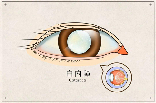 白内障眼睛示意图