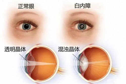 正常眼和白内障眼晶体对比漫画示意图
