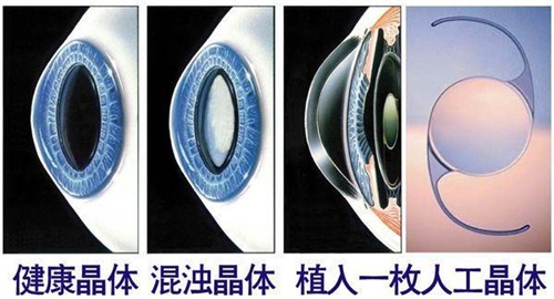 健康晶体和混浊晶体以及认同晶体植入后眼球对比图