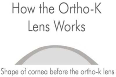 戴角膜塑形镜前 戴角膜塑形镜前