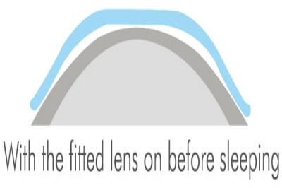 睡觉前戴上合适的角膜塑形镜 睡觉前戴上合适的角膜塑形镜