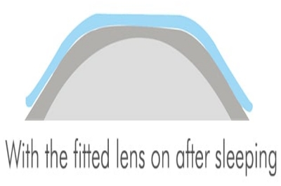 睡觉后角膜塑形镜调整角膜形态 睡觉后角膜塑形镜调整角膜形态