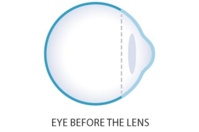 角膜塑形镜 角膜塑形镜