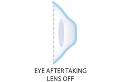 角膜塑形镜 角膜塑形镜