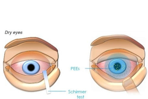 干眼检查动画示意图 干眼检查动画示意图