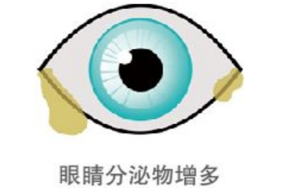 干眼症症状示意图 干眼症症状示意图
