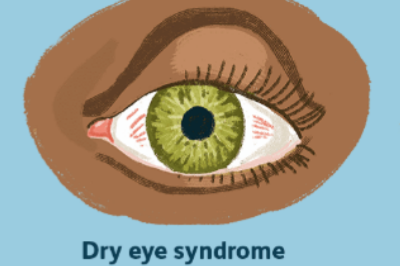干眼症症状示意图
