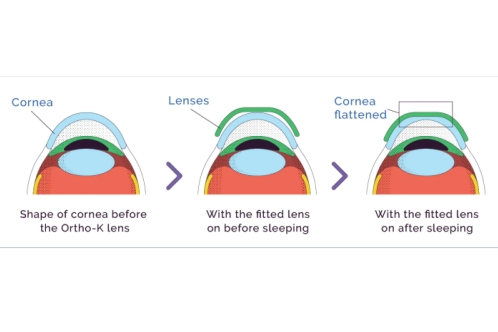 角膜塑形镜眼部动画示意图 角膜塑形镜眼部动画示意图