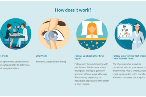 角膜塑形镜使用动画示意图 角膜塑形镜使用动画示意图