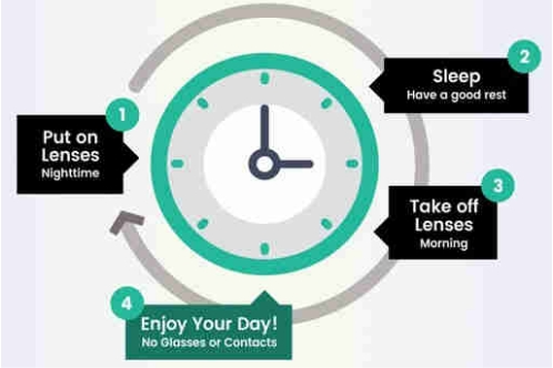 角膜塑形镜的使用时间示意图 角膜塑形镜的使用时间示意图