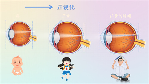 婴幼儿到成人眼轴长度发展变化漫画图