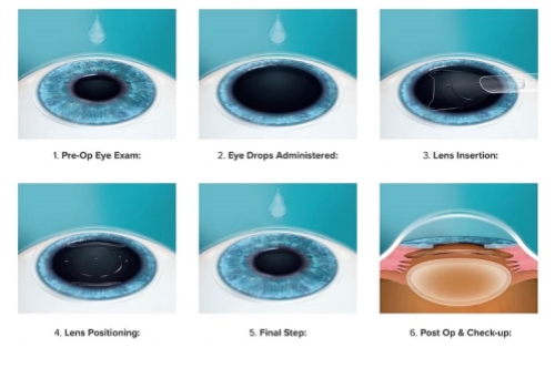 晶体植入术示意图 晶体植入术示意图