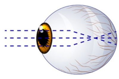 揭秘：高度近视会发生哪些并发症?附预防高度近视并发症方法！